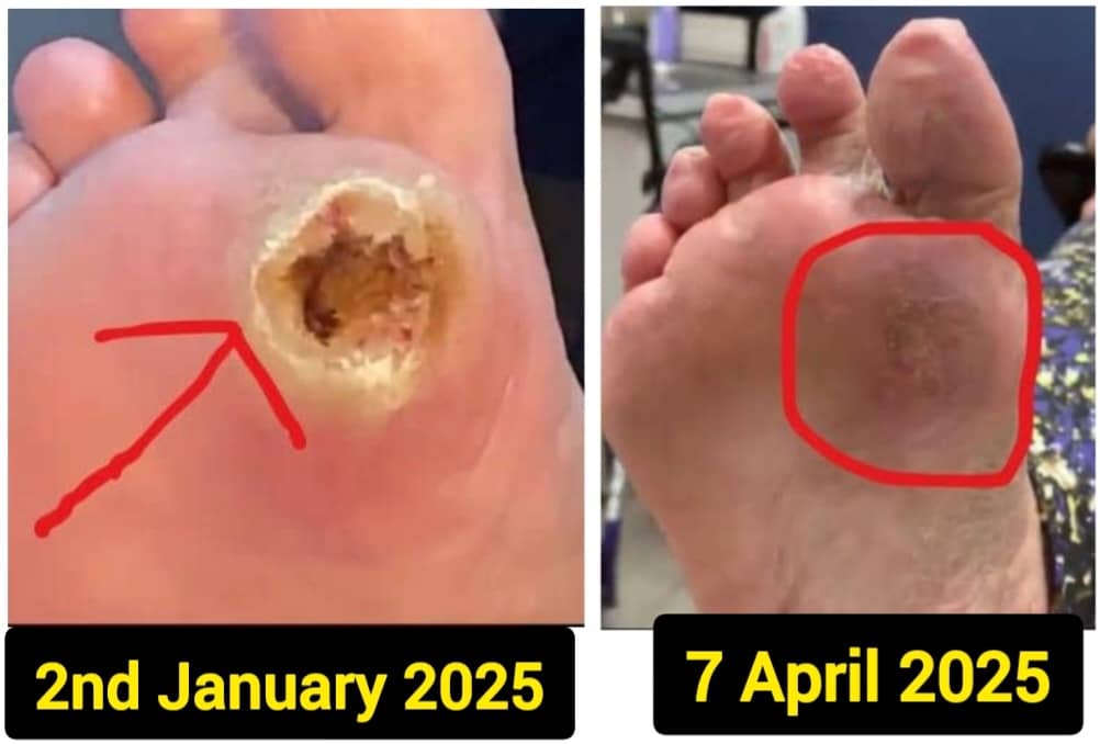 Before and after foot healing