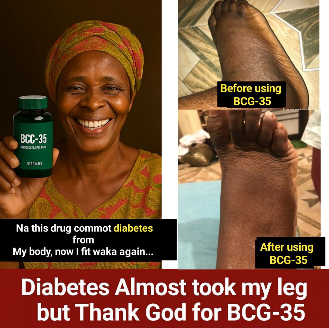 Diabetes complications